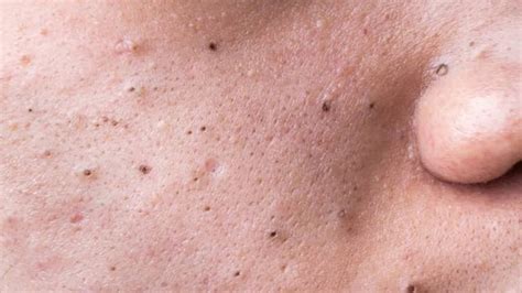 fat blackheads popping